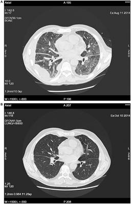 Case report: VEXAS as an example of autoinflammatory syndrome in pulmonology clinical practice